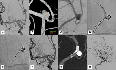 Case report: Treatment of anterior cerebral artery aneurysms with combined remodeling technique and flow diverter deployment through a dual lumen balloon catheter